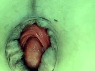 我的脱垂被拉伸